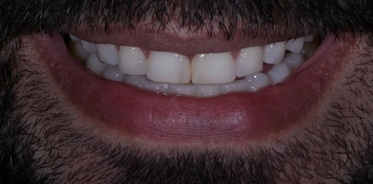 Antes: Reabilitação com facetas