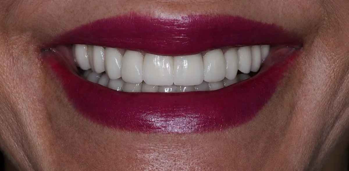 Cirurgia estética gengival, resultado